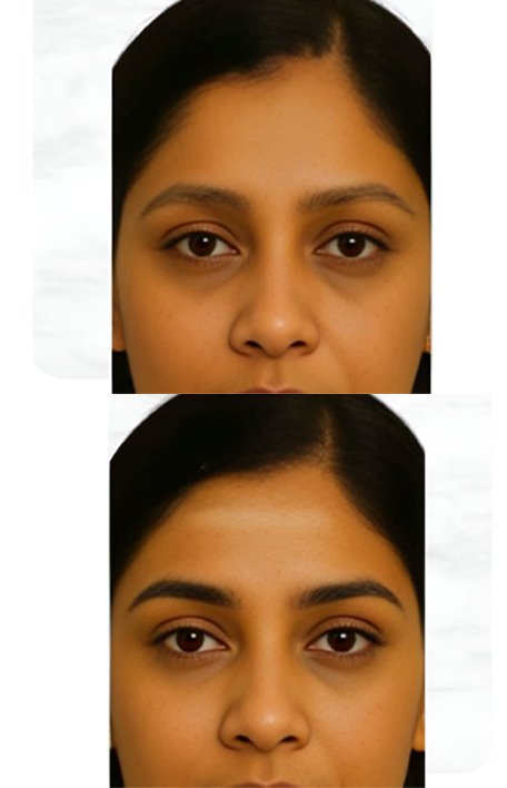 eyebrow-reconstruction-service